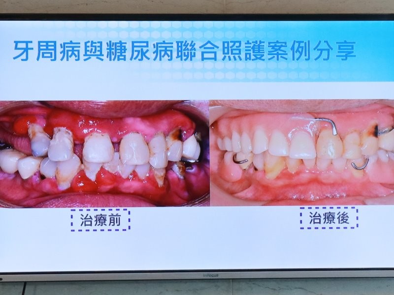 牙齒脫落　高血糖讓牙周病菌更易生存