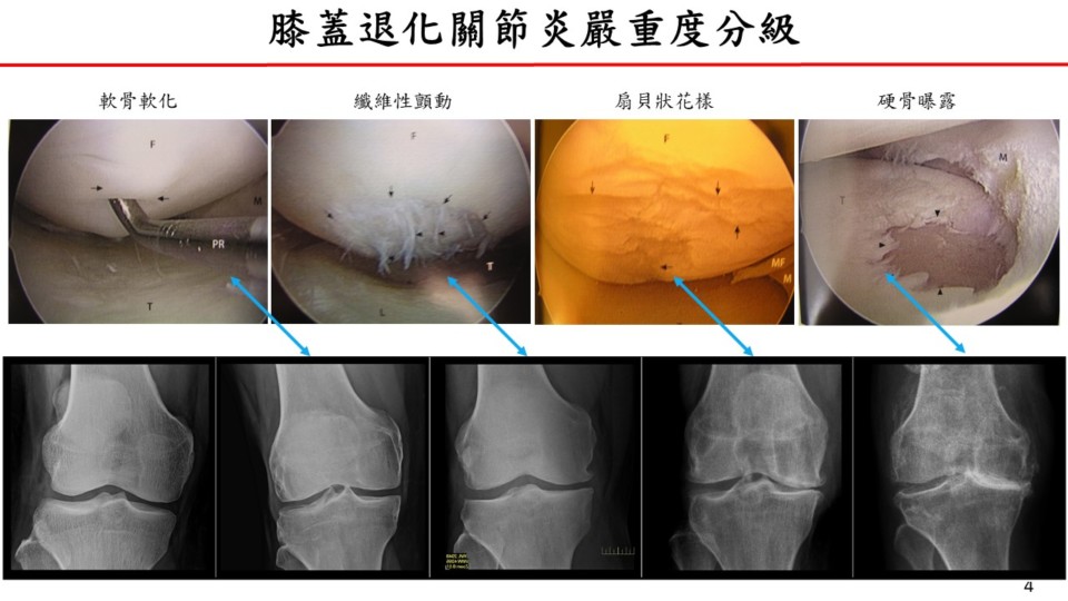 幹細胞治退化性關節炎  重拾高爾夫球揮桿樂趣