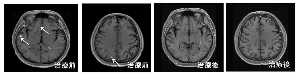 37歲吸菸男頭痛 肺癌腦轉移作祟