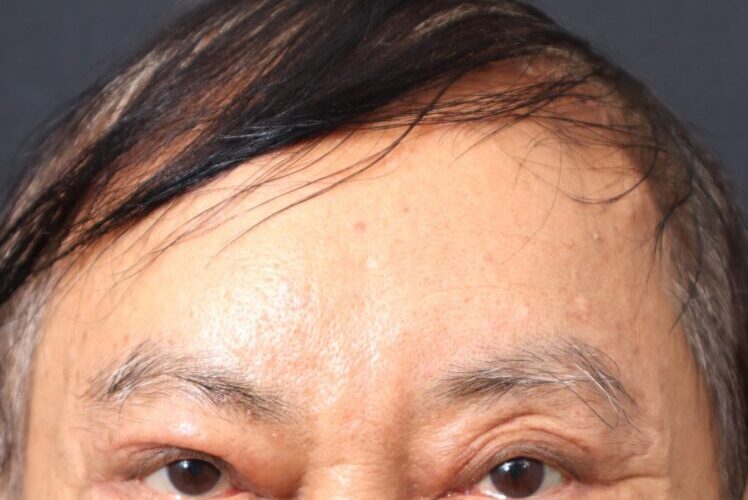 額頭拉皮還我年輕本色 資深醫師整形追夢 再創事業第二春
