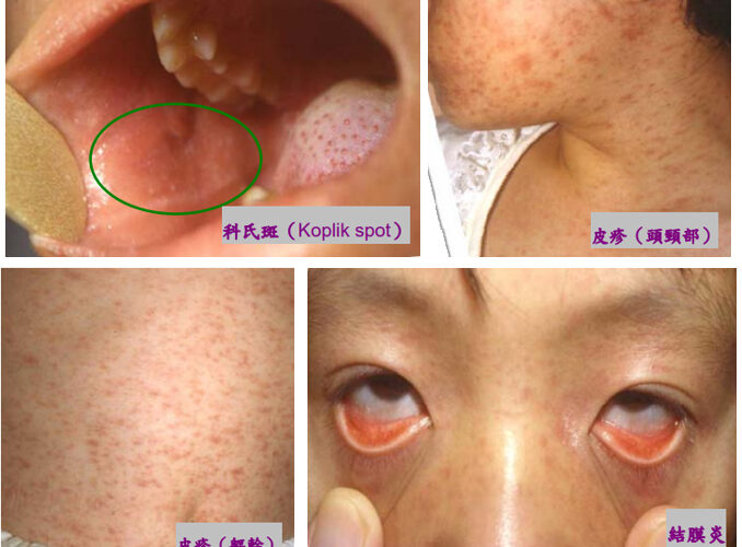近期國外麻疹疫情嚴峻　連假出國要注意麻疹疫情