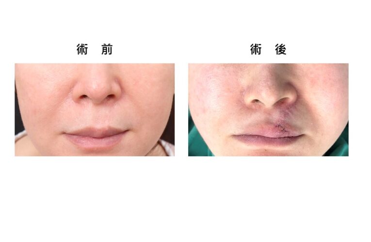 曹賜斌醫師獨創白疤再生術  助患者揮別童年傷痕回歸正常生活