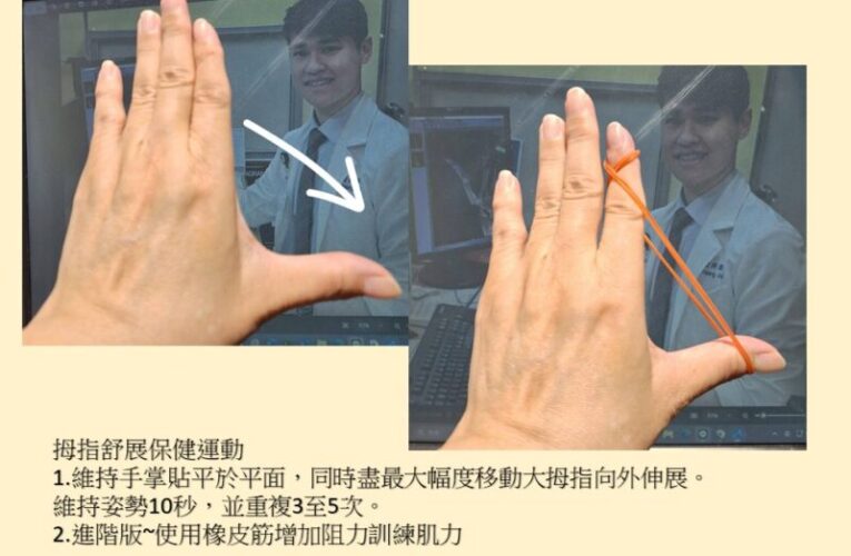 拇指腕掌關節炎年輕化！阮綜合醫院助患者術後重返職場