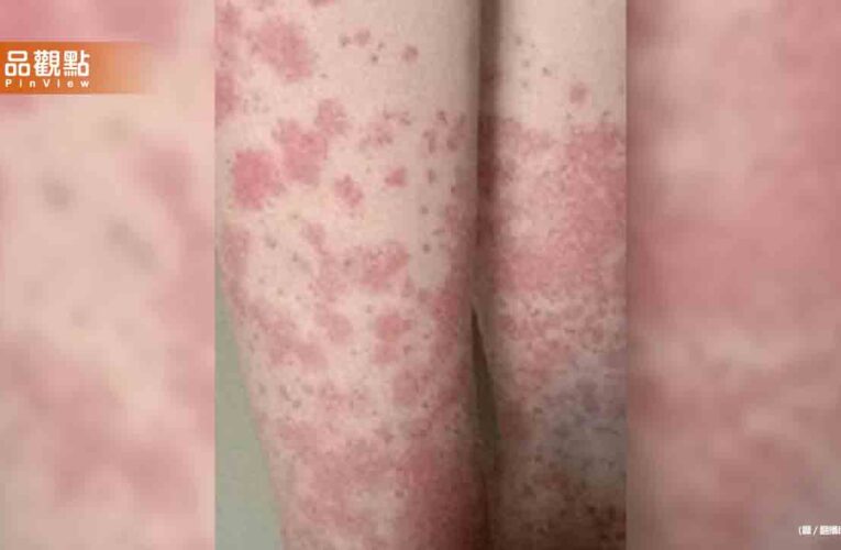 20歲女大生狂染髮「全身爆紫斑」險喪命
