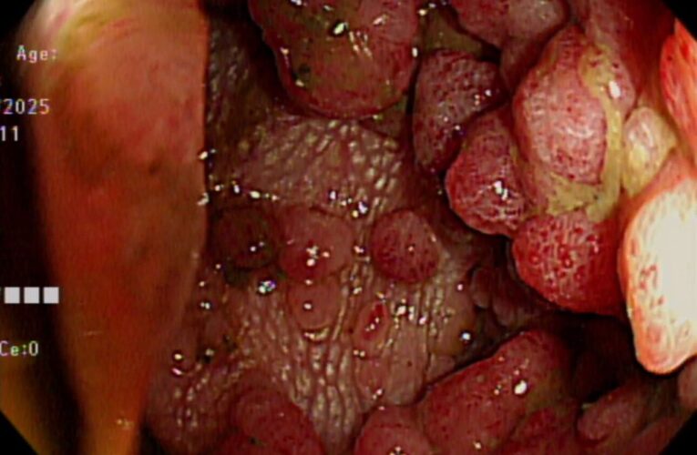 罕見FAP潛伏腸道　男子腸道長滿瘜肉　恐怖遺傳病忽略恐成癌