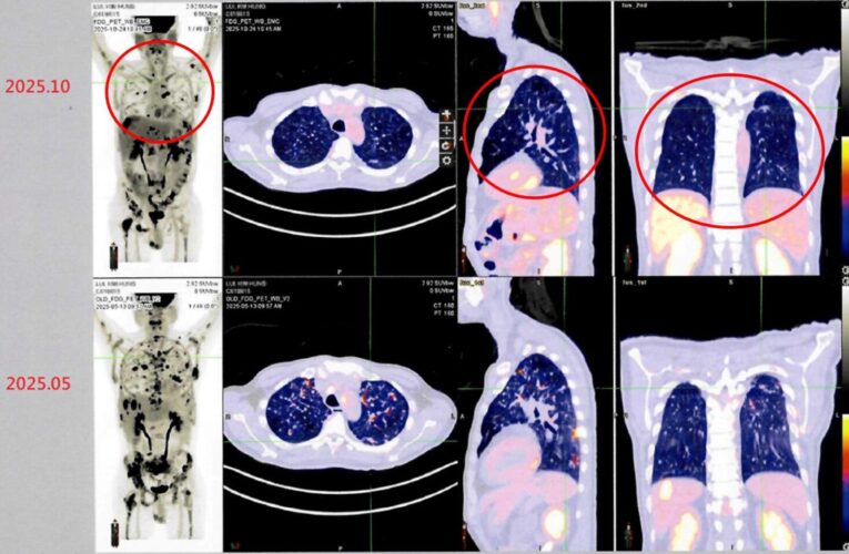 台灣細胞治療技術展現新希望　跨國癌症患者肯定臨床成果