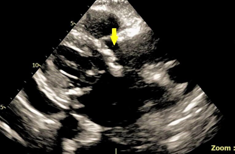 主動脈瓣狹窄　老婦反覆肺水腫、雙腳腫脹難以行走　