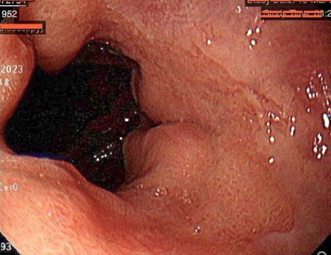 忍忍就沒事的輕微腹痛腹瀉 恐是肚子著涼 丁楷庭醫師：冬季是腸胃病高峰期 腹部保暖很重要