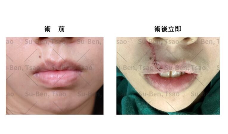 寵物當家抓咬唇部白疤有救 曹賜斌醫師助飼主重拾失落平安