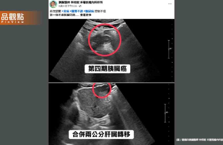 血糖失控竟是癌王警訊！50歲男確診胰臟癌四期已轉移肝臟